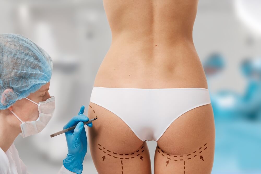 Brazilian Butt Lift (BBL) | Natural Butt Augmentation & Shaping